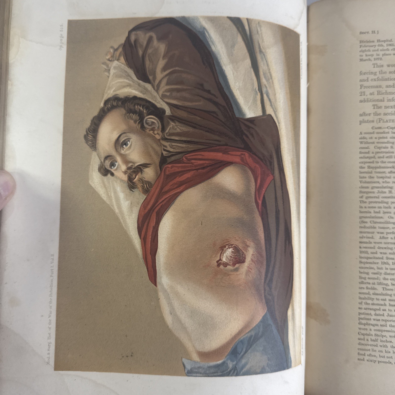 1861-65 Surgeon General Report “THE MEDICAL & SURGICAL HISTORY OF THE REBELLION”
