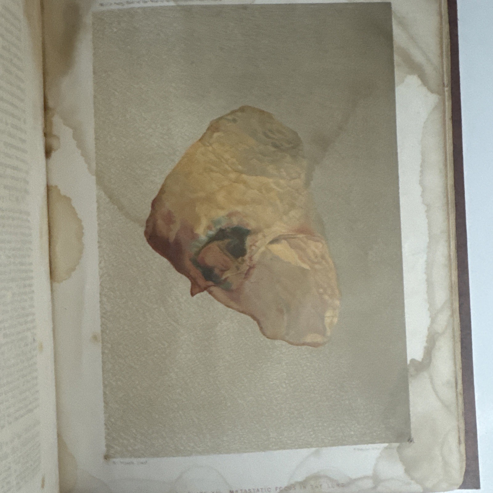 1861-65 Surgeon General Report “THE MEDICAL & SURGICAL HISTORY OF THE REBELLION”